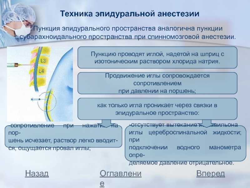 Схема эпидуральной анестезии