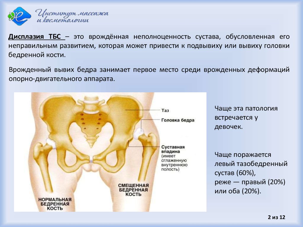 Врожденный вывих бедра презентация