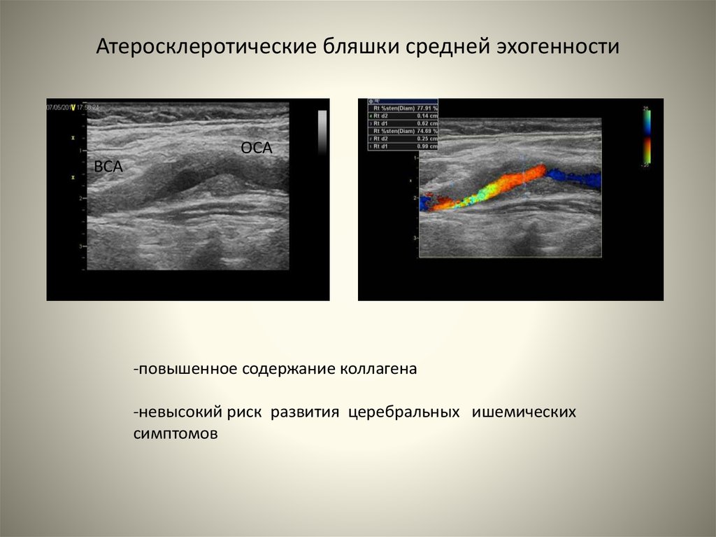 Эхографические признаки атеросклеротического. Эхоструктура это УЗИ. Эхогенность при ультразвуковом исследовании. Средняя эхогенность железы что это такое. Эхогенность при УЗИ.