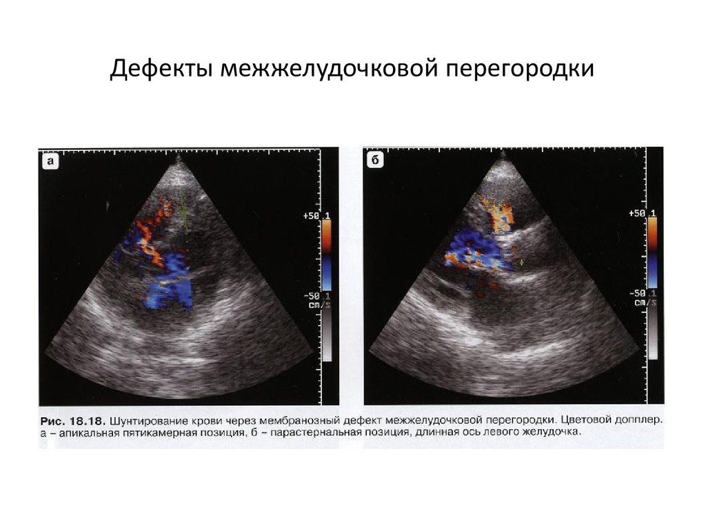 Дефект межжелудочковой перегородки картинки