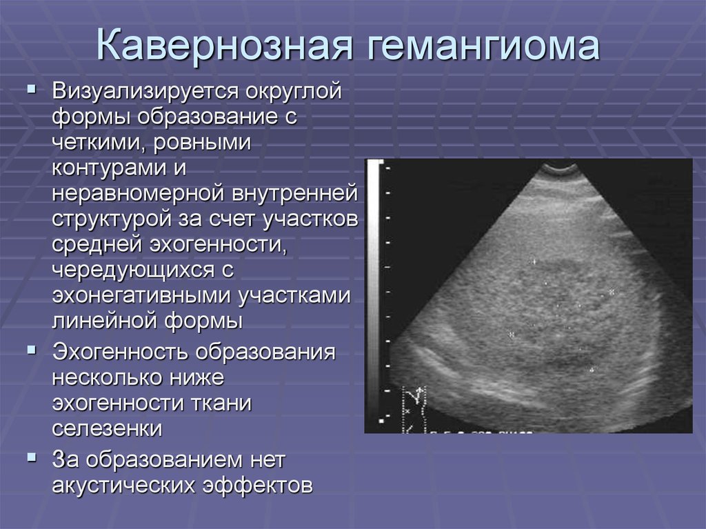 Эхографическую картину кавернозной гемангиомы печени необходимо дифференцировать с