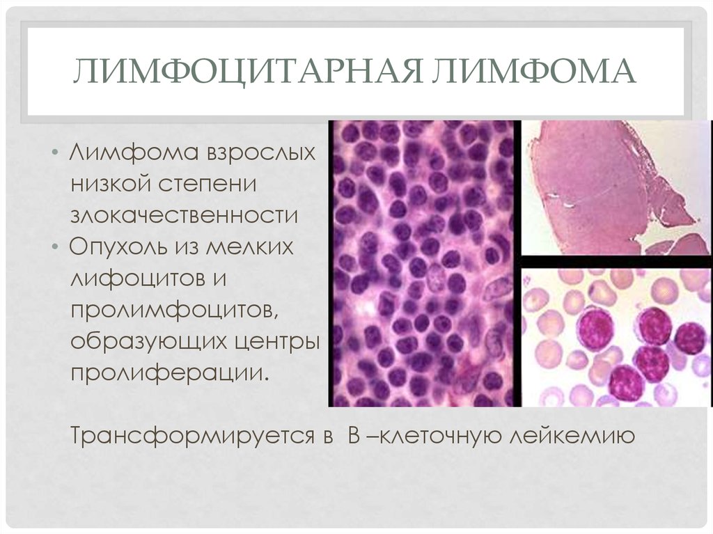 Болезнь ходжкина картина крови