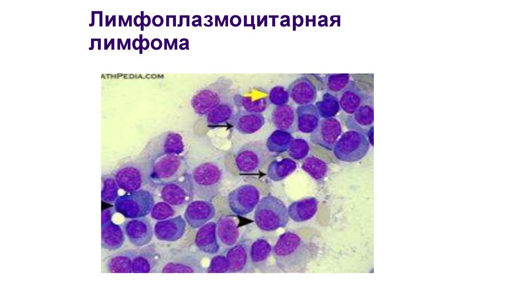 Волосатоклеточный лейкоз картина крови