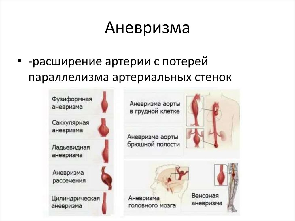 Презентация аневризмы сосудов головного мозга