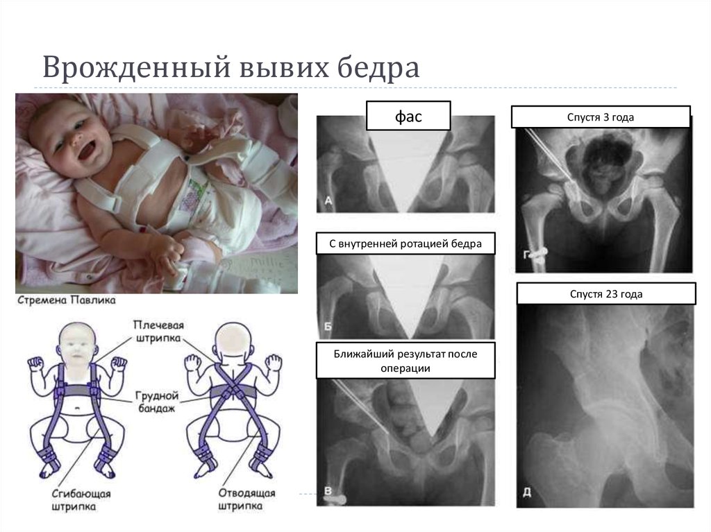 Для клинической картины врожденного вывиха бедра характерны симптомы