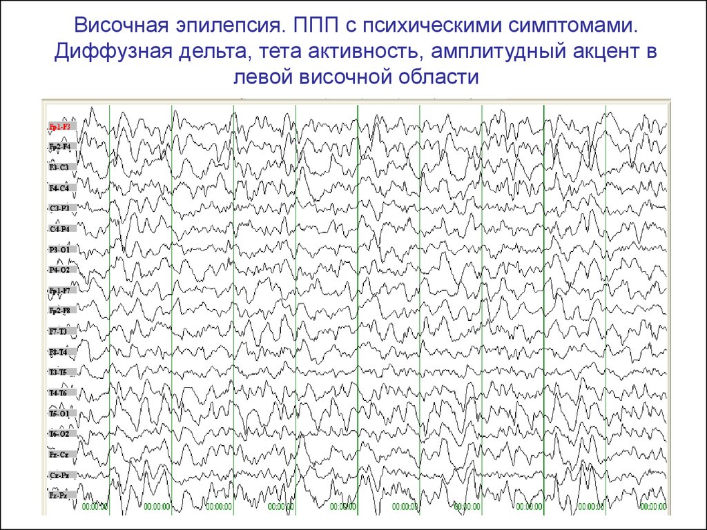 Ээг показывает эпилепсию. Электроэнцефалография, норма, ЭЭГ, видеомониторинг ЭЭГ при эпилепсии\. ЭЭГ головного мозга эпилепсии. Эпилептиформная активность на ЭЭГ. ЭЭГ при эпилептическом припадке.