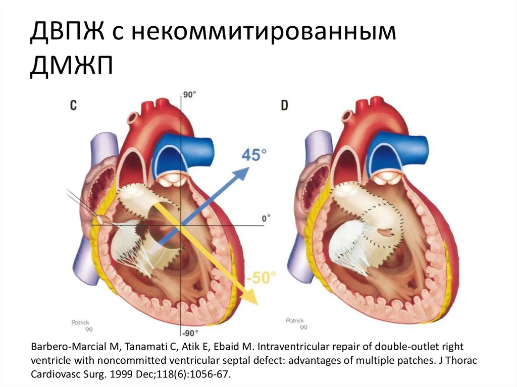 Дефект межжелудочковой перегородки