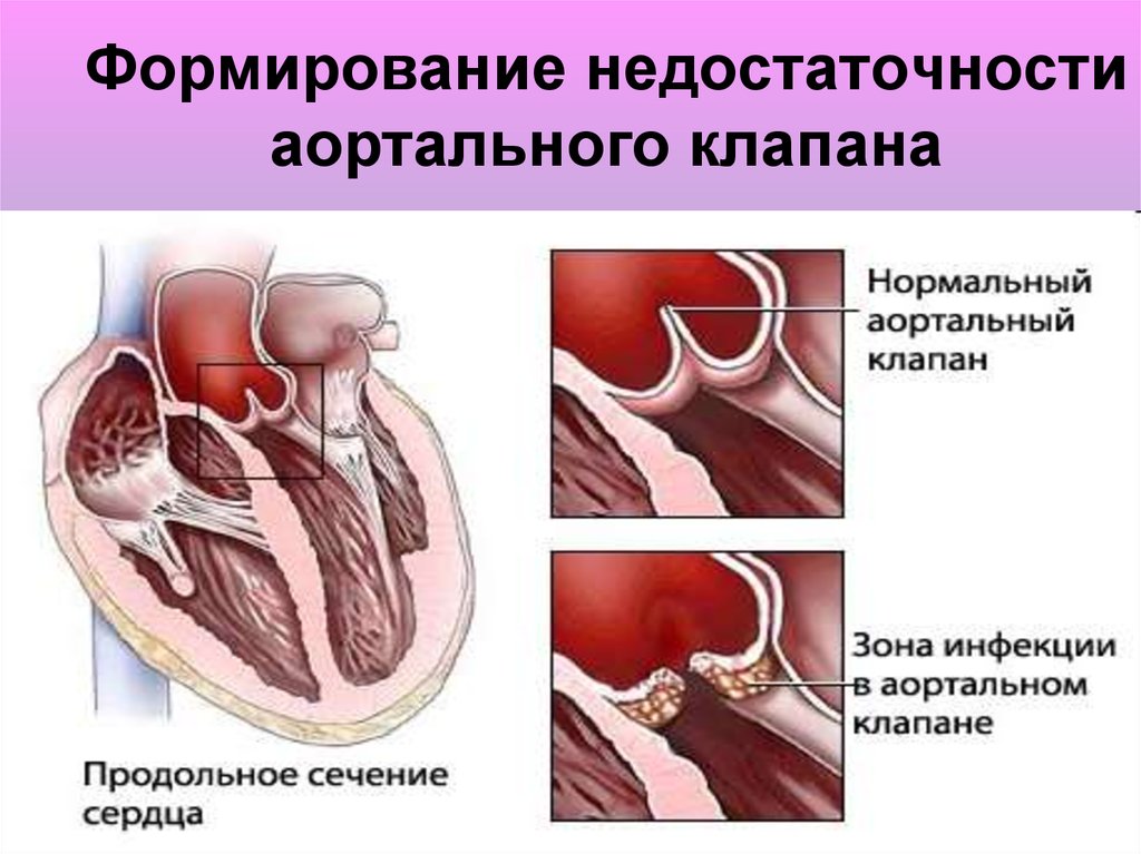 Аортальная недостаточность презентация