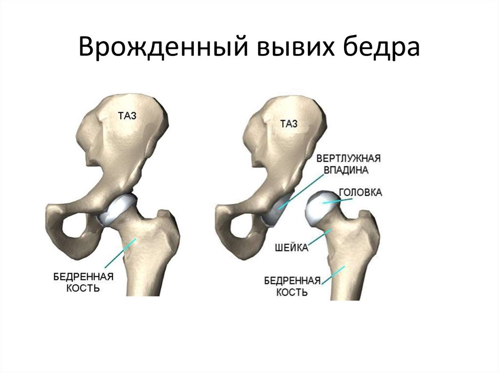 Врожденный вывих бедра презентация травматология