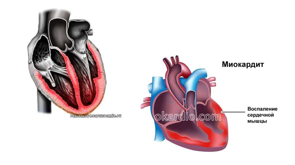 Миокардит. Воспаление миокарда миокардит. Миокардит эндокардит животных.