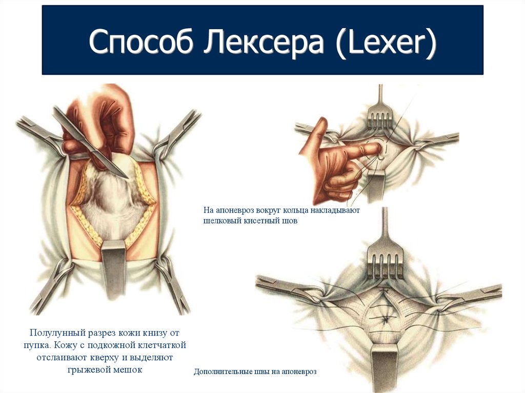 Грыжи передней брюшной стенки презентация