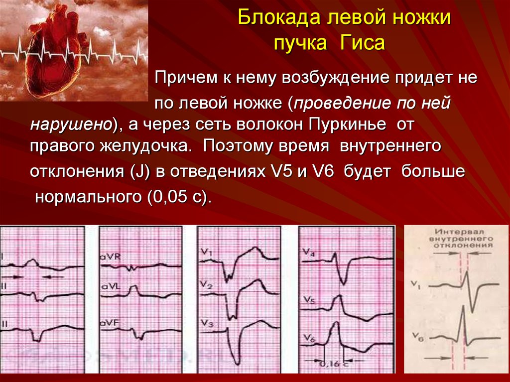 Неполная блокада правой ножки пучка гиса картинки