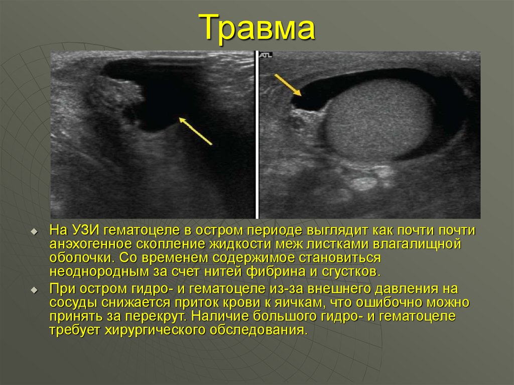 Водянка яичка у детей презентация