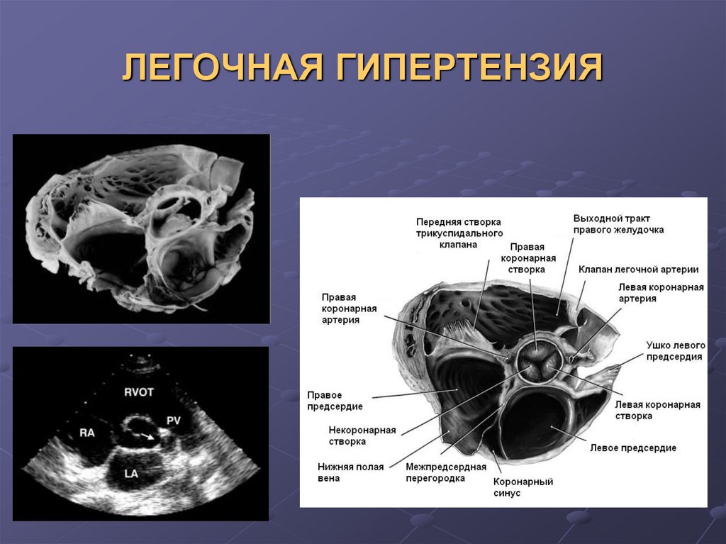 Легочная гипертензия что. Легочная гипертензия. Первичная легочная гипертензия. Легочная гипертензия легочной артерии показатели. Повышение давления в легочной артерии причины.