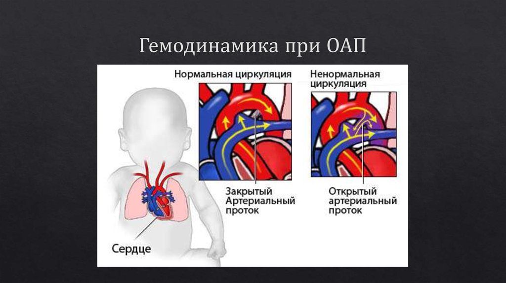 Схема открытого артериального протока