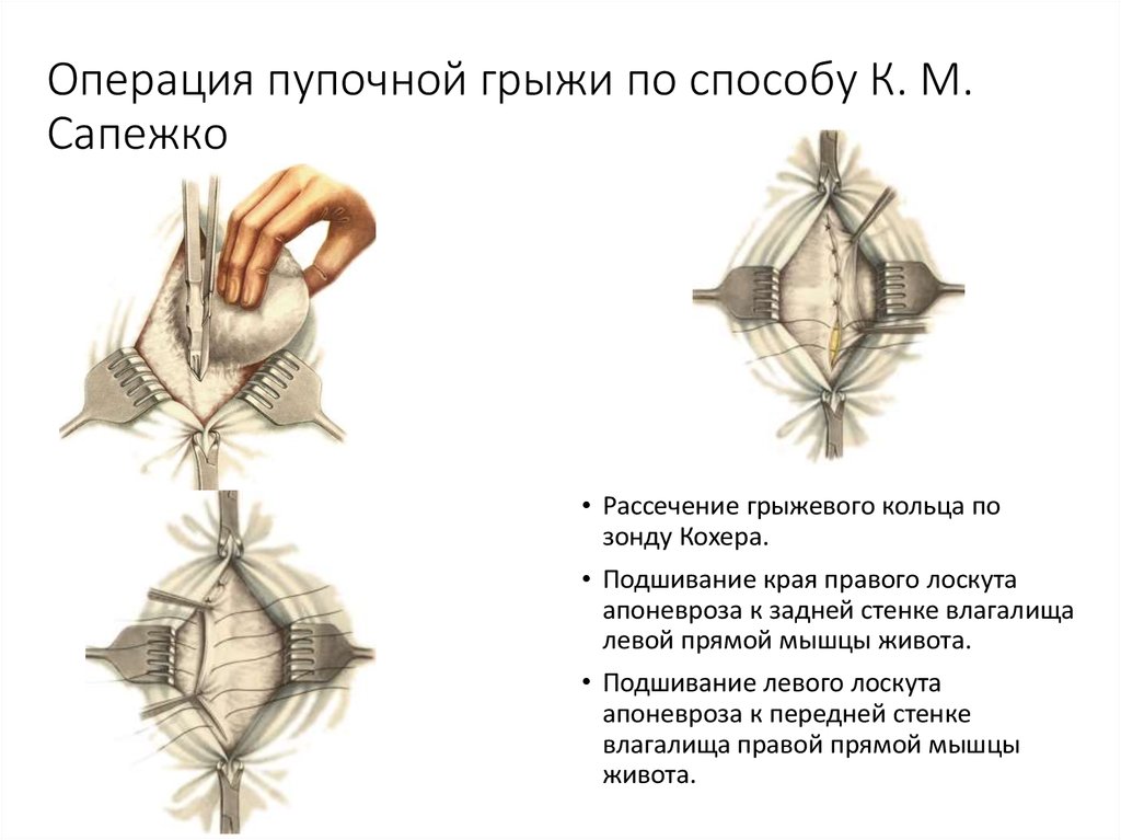 Пластика грыж по сапежко