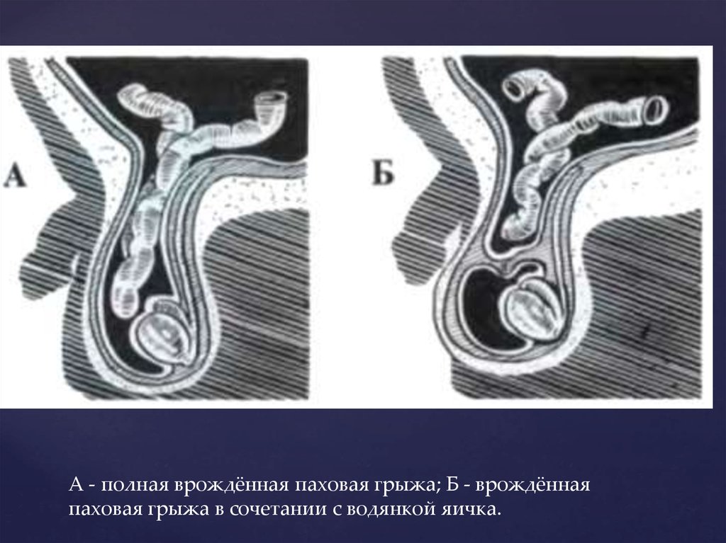 Что такое паховая грыжа у женщин показать на рисунке