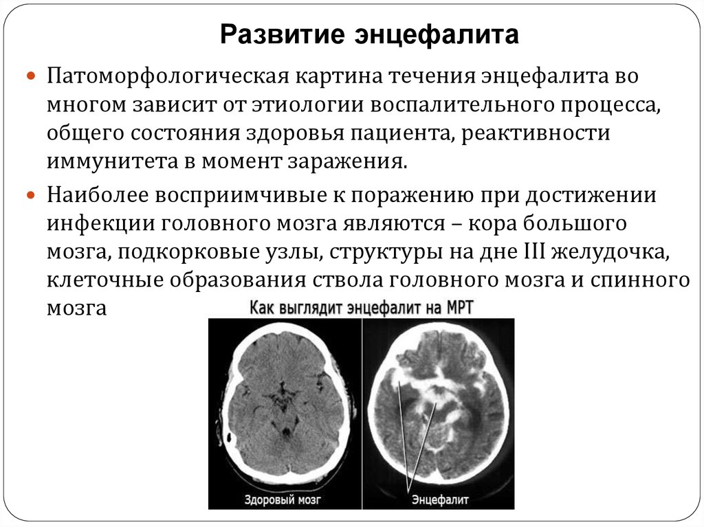 Энцефалит головного мозга у взрослых. Клещевой энцефалит поражение головного мозга. Герпетический энцефалит кт.