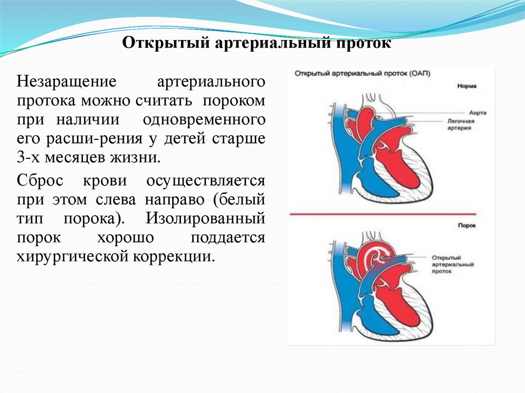 Оап у новорожденных. Открытый артериальный проток 0,5мм. Открытый аортальный проток у детей. Открытый боталлов проток патанатомия. Открытый боталлов проток у новорожденного.