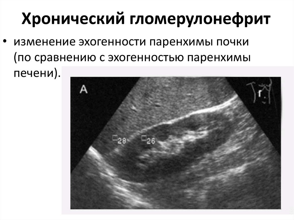 Эхографическая картина почек