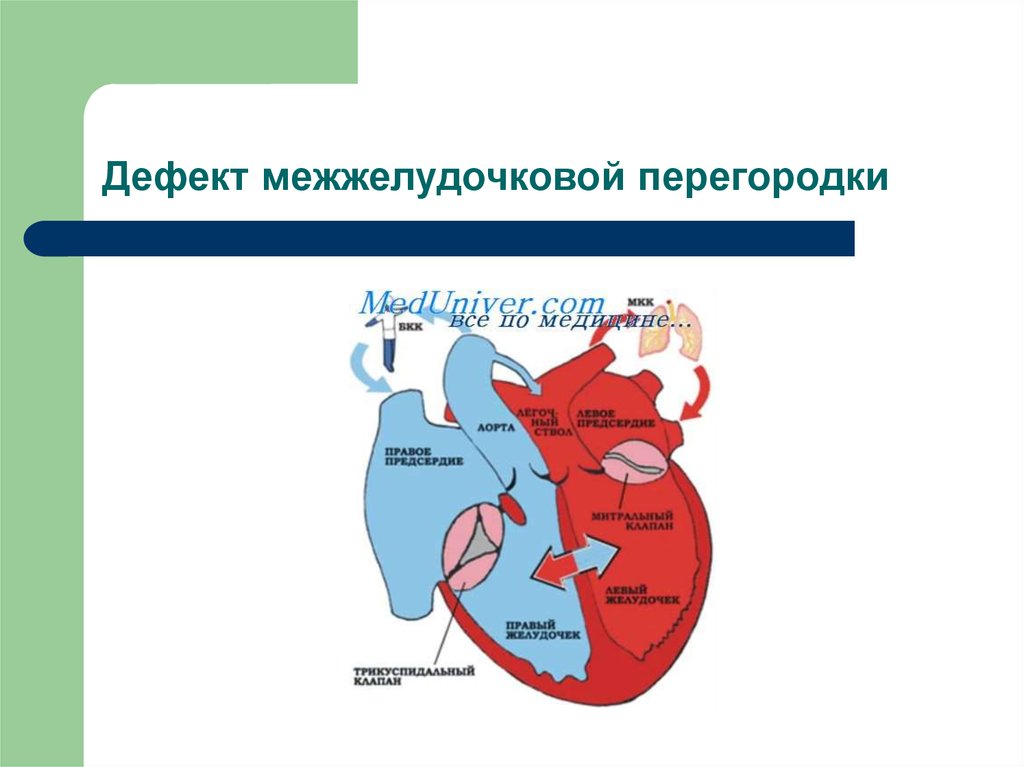 Дефект межжелудочковой перегородки презентация