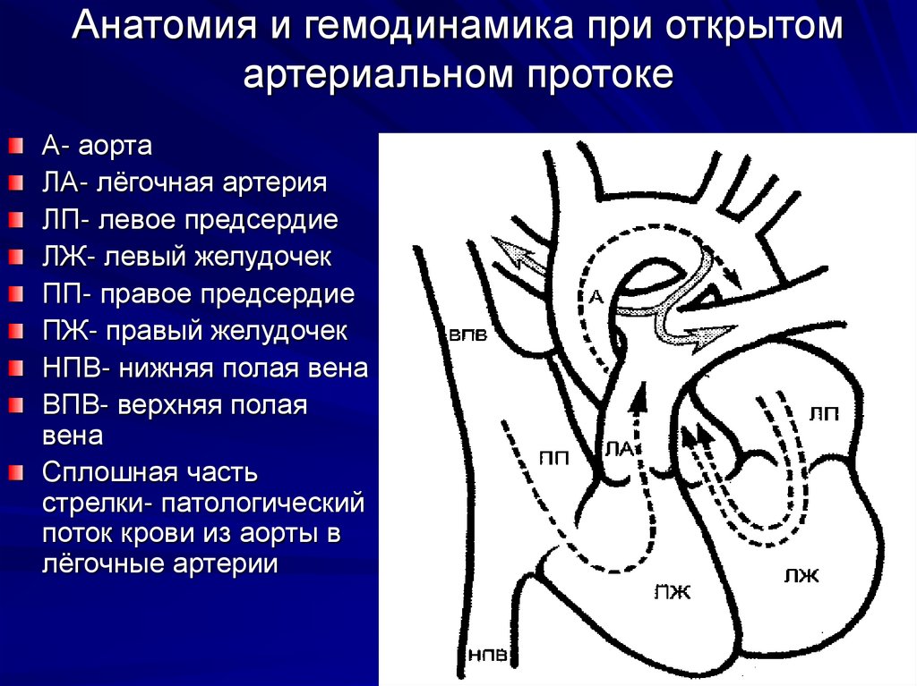 Схема открытого артериального протока