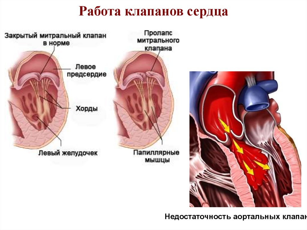 Пролапс митрального клапана презентация