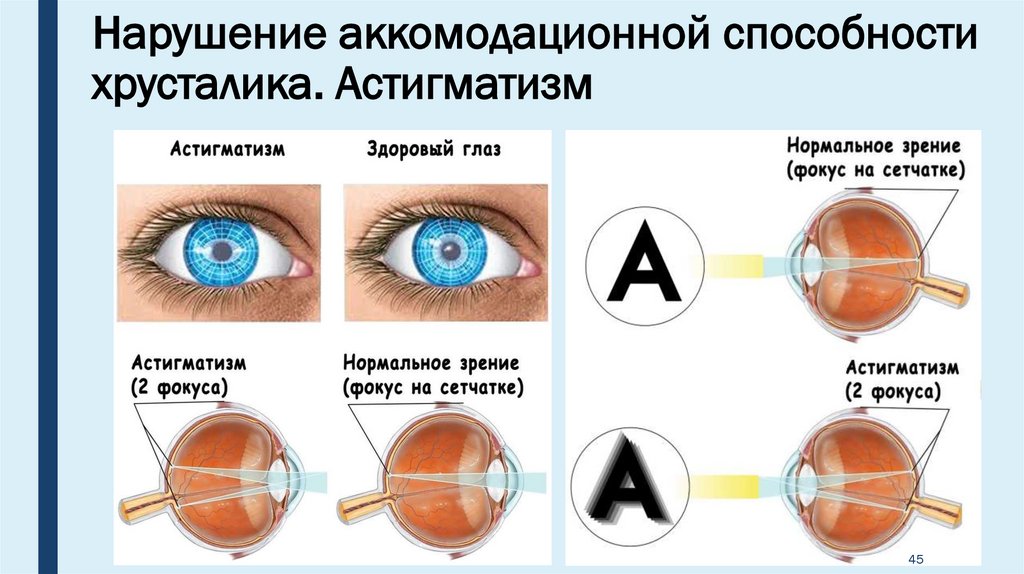 Коррекция астигматизма. Астигматизм и косоглазие. Астигматизм хрусталика. Астигматизм и нормальное зрение. Хронический астигматизм.