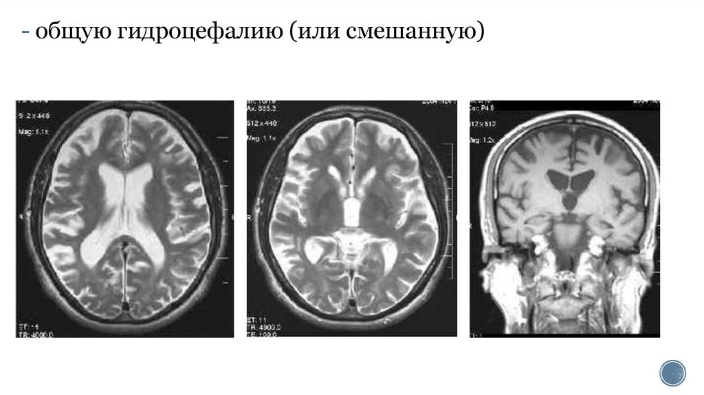 Мр картина смешанной заместительной гидроцефалии