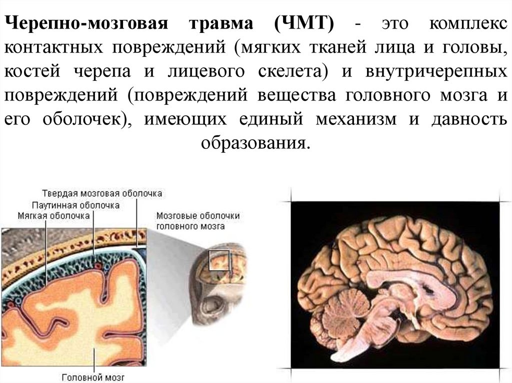 После черепно мозговой. Черепно-мозговая травма. ЧМТ механизм возникновения. Черепно-мозговая травма кратко. Черепно мозговая травма черепно.