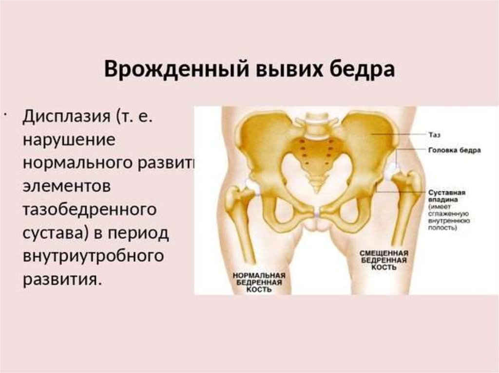 Врожденный вывих бедра презентация травматология