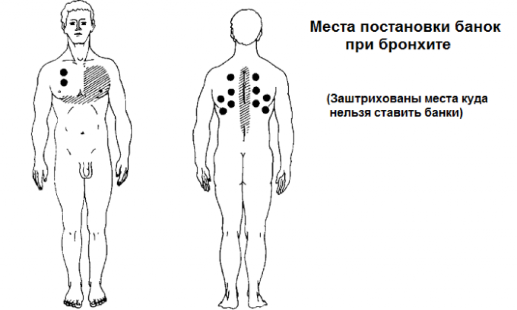 Места постановки банок схема