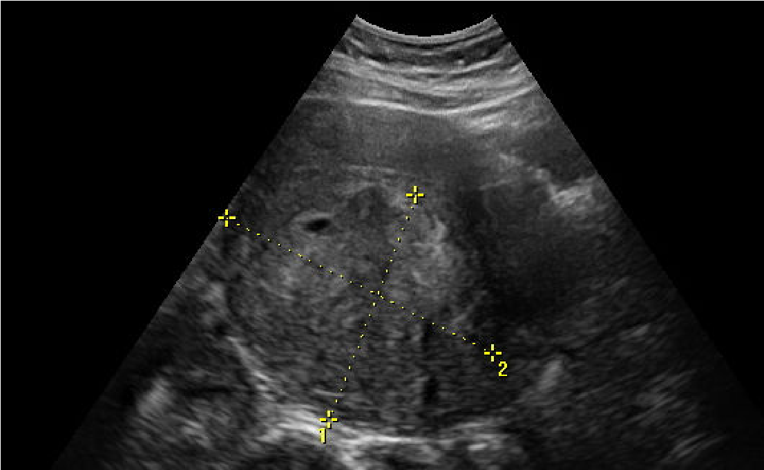Узи картина миомы матки
