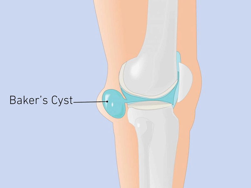 Упражнения при кисте бейкера коленного сустава фото