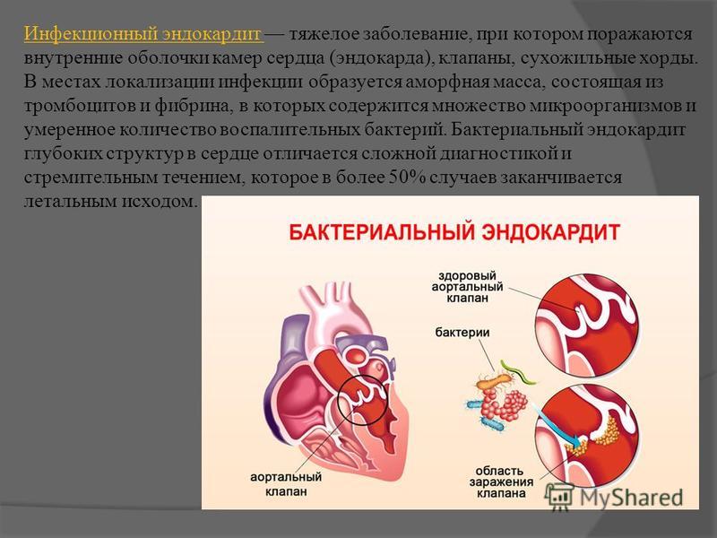 Презентация эндокардиты у детей