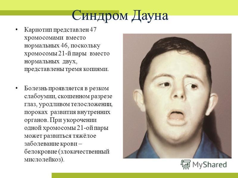 Синдром дауна люди с синдромом дауна