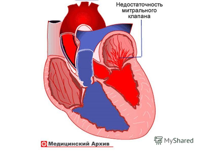 Недостаточность митрального клапана. Сердечная недостаточность митрального клапана. Митральный клапан схема. Недостаточность митрального клапана порок.