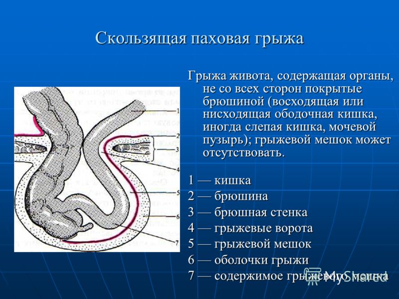 Может ли паховая грыжа. Скользящая грыжа слепой кишки. Строение паховой грыжи. Скользящая прямая паховая грыжа.