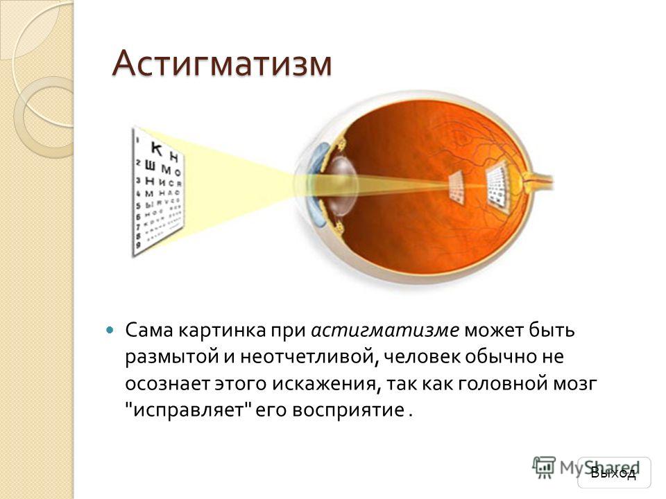 Астигматизм. Сложный дальнозоркий астигматизм. Сложный близорукий астигматизм. Астигматизм миопический сложный , амблиопия.