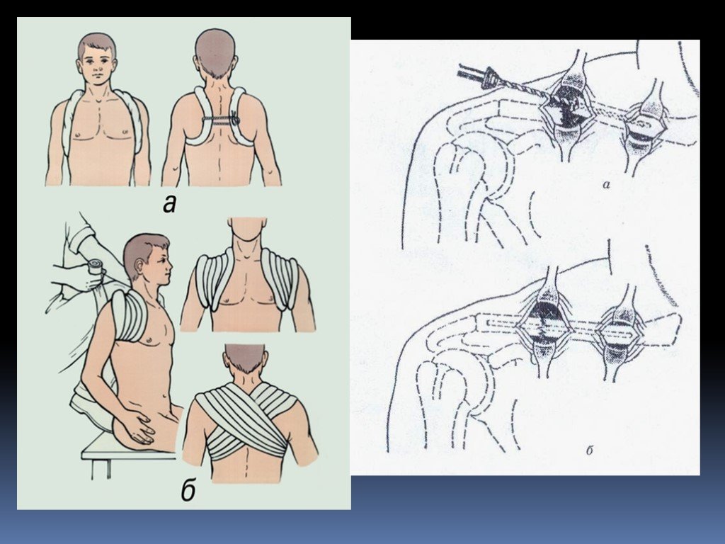 Хирургические заболевания грудной клетки. Повязка восьмерка при переломе ключицы. Восьмиобразная повязка при переломах ключицы. Повреждения грудной клетки.