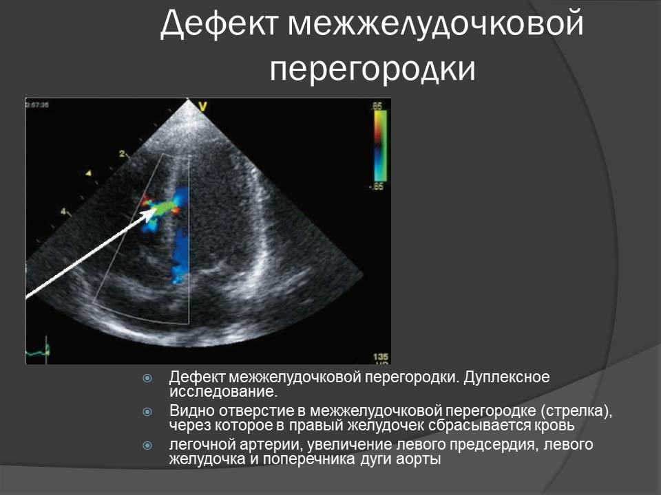 Дмпп аускультативная картина