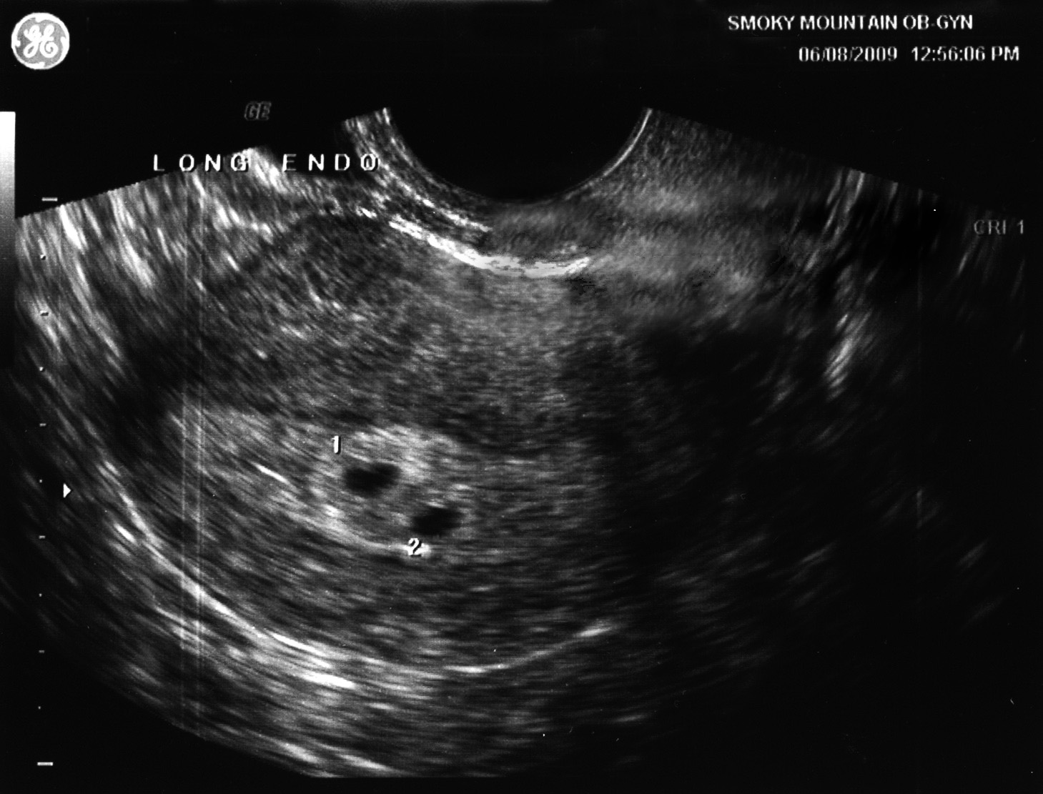 Узи срок 3 недели. УЗИ двойняшек на 4 неделе беременности. УЗИ 1-2 недели беременности фото плода. Снимок УЗИ на 1 неделе беременности двойня.