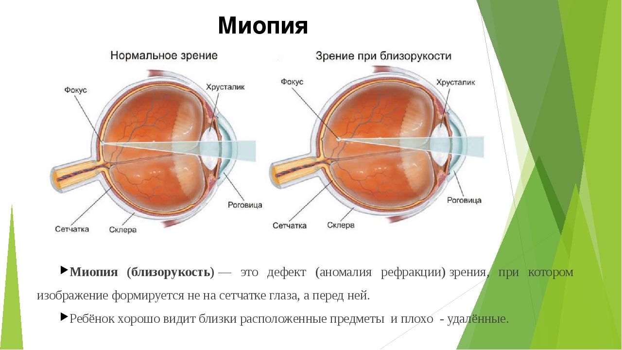 Пропадает зрение на одном глазу. Миопия дальнозоркость астигматизм. Зрение 2.5 астигматизм. Глаз при астигматизме схема. Астигматизм хрусталика.
