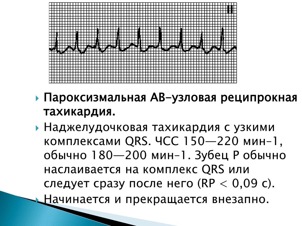 Наджелудочковая тахикардия презентация