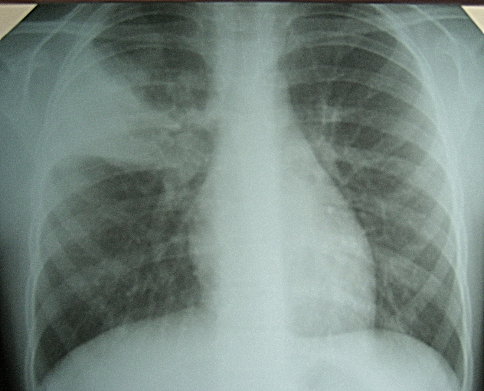 Легкое течение пневмонии. Пневмония снимок легких у ребенка. Воспаление лёгких у детей. Пневмония на рентгене.